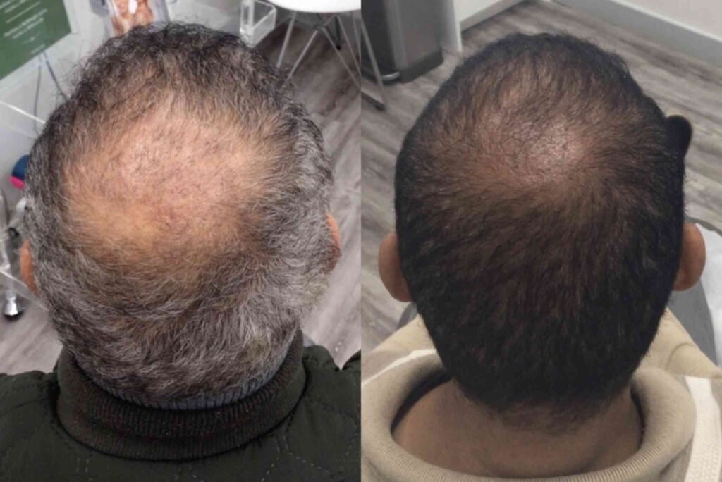 Hair Transplant Turkey